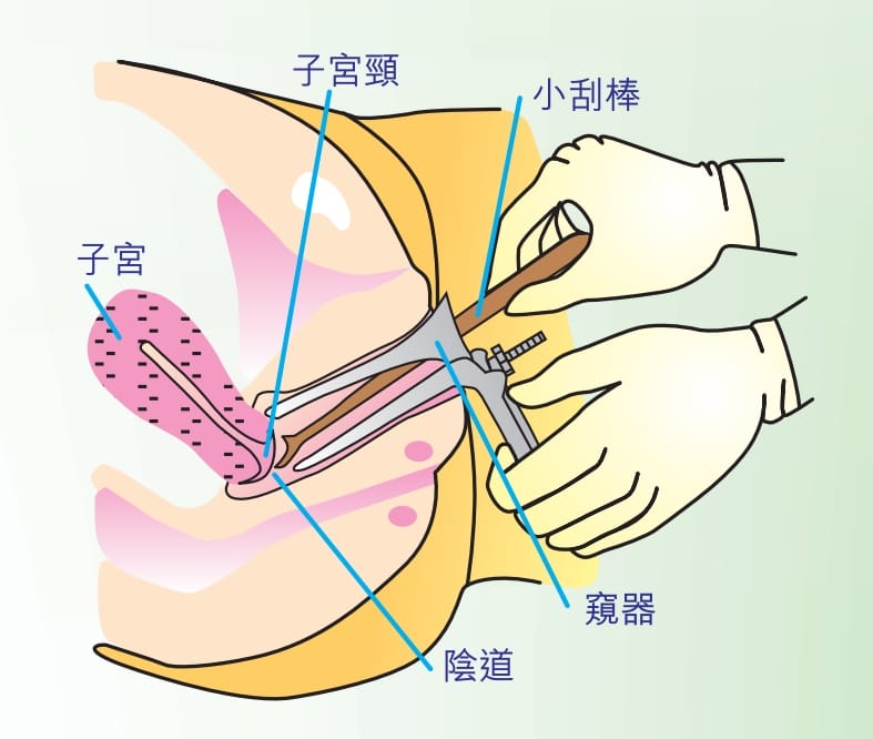子宮頸抹片檢查費用($440)及須知︱Urban Medical 德立醫療 子宮頸抹片檢查費用($440)及須知︱Urban Medical 德立醫療
