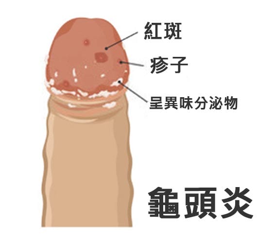 龜頭炎病徵