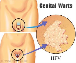 HPV genital warts in men and women