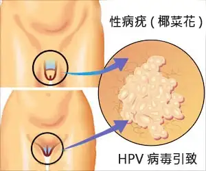 HPV性病疣(椰菜花)的病徵