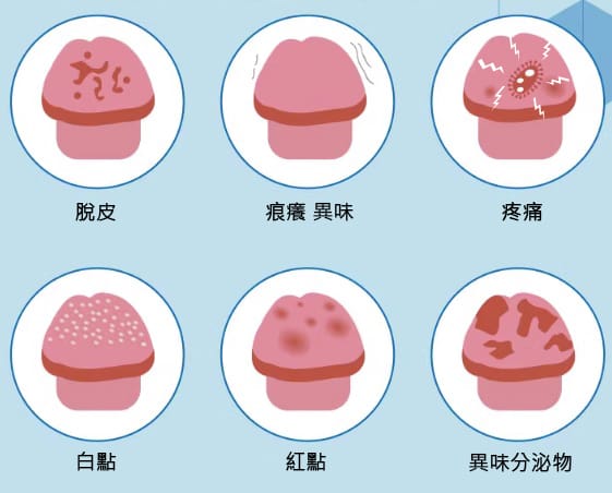 龜頭炎癥狀：脫皮, 痕癢, 痛, 紅點(diǎn)