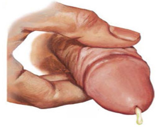 尿道口明顯紅腫，擠出黃色膿液